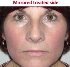 New SilkN Reju Treats Wrinkles Spots Fine Lines Pores